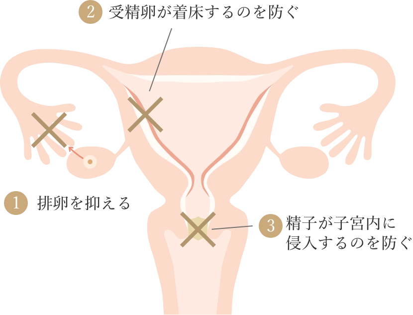 女性の子宮、卵巣、卵管、および子宮頸管の概略図。避妊方法（経口避妊薬などのメカニズム）が作用する3つの主なポイントを、バツ印（X）と番号付きのテキストで示している。妊娠成立を防ぐために、「排卵抑制」「着床防止」「精子侵入阻止」の3つの段階で作用する仕組みを解説。